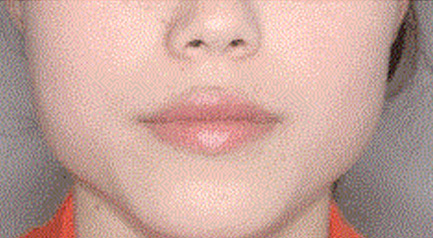 mplant_chin_img5
