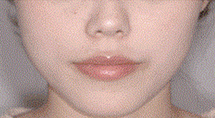 mplant_chin_img6