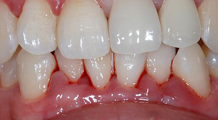 mplant_gum_img1