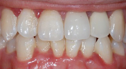 mplant_gum_img2