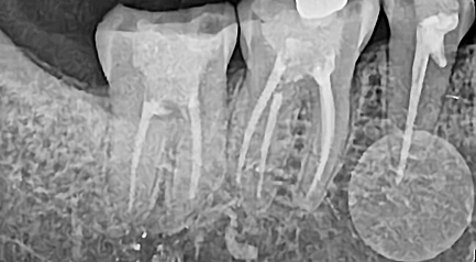 Mplant Nerve Img2