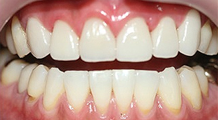 mplant_zirconia_img2