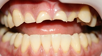 mplant_zirconia_img3