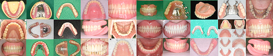 mplant_dentures_img2