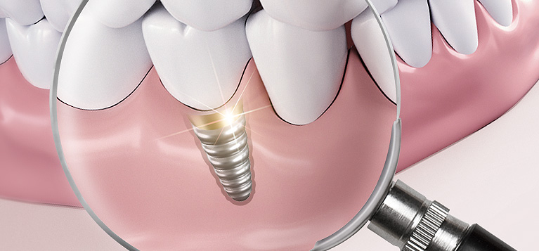 mplant_implant2_img2_