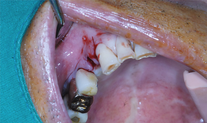 mplant_implant2_img3