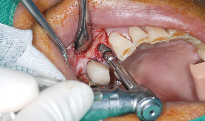 mplant_implant2_img4