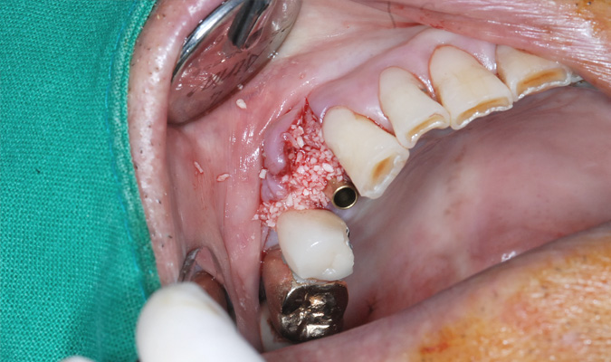 mplant_implant2_img5