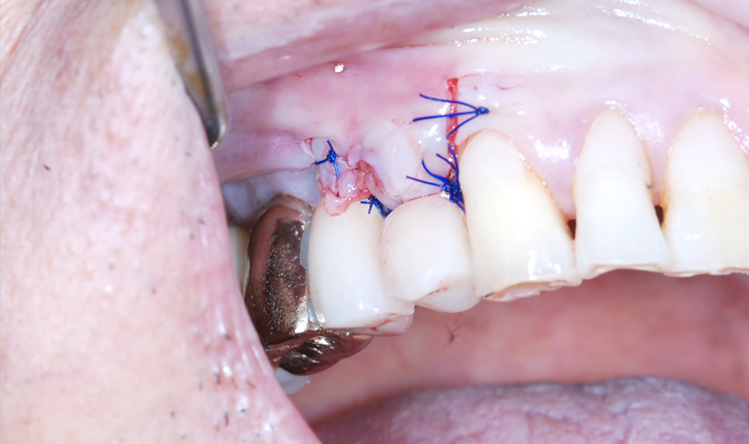 Mplant Implant2 Img6