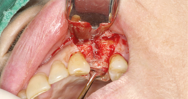mplant_implant3_img2