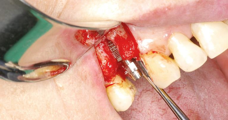 mplant_implant3_img3-2