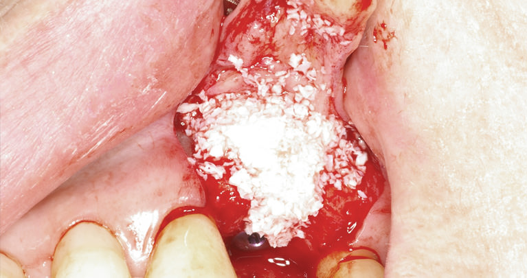 mplant_implant3_img4-