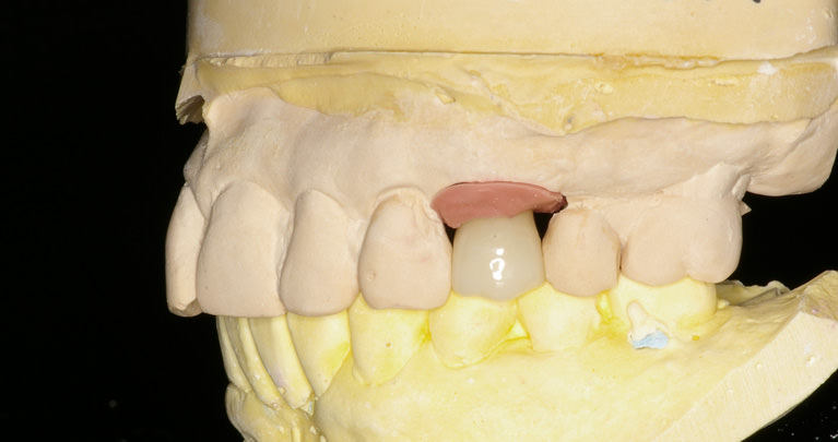mplant_implant3_img6