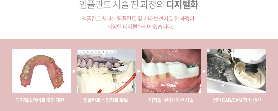 mplant_implant7_210615