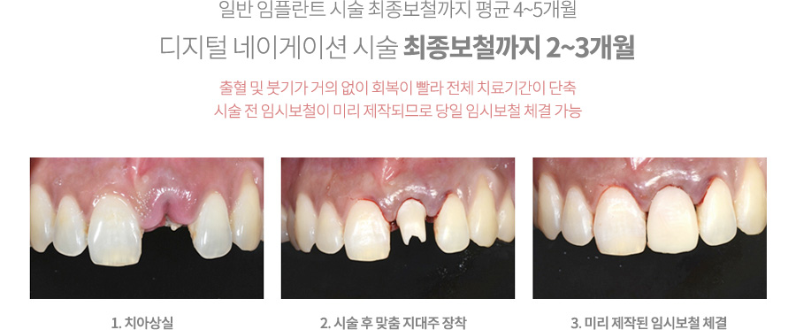 mplant_implant7_img2