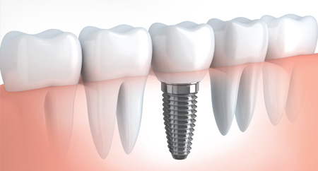 mplant_implant_img6-03