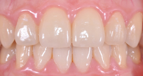 sample_tooth2