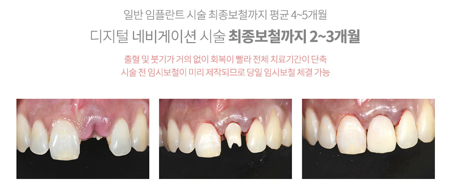 임플란트페이지_수정